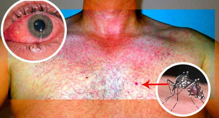 Aumentan 60% infectados por virus del zika en Sinaloa en 7 días