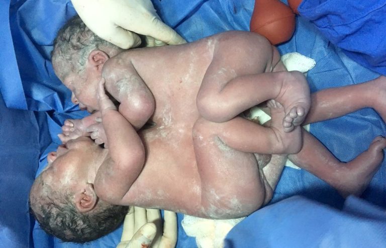 Separan con éxito a siameses en Guanajuato