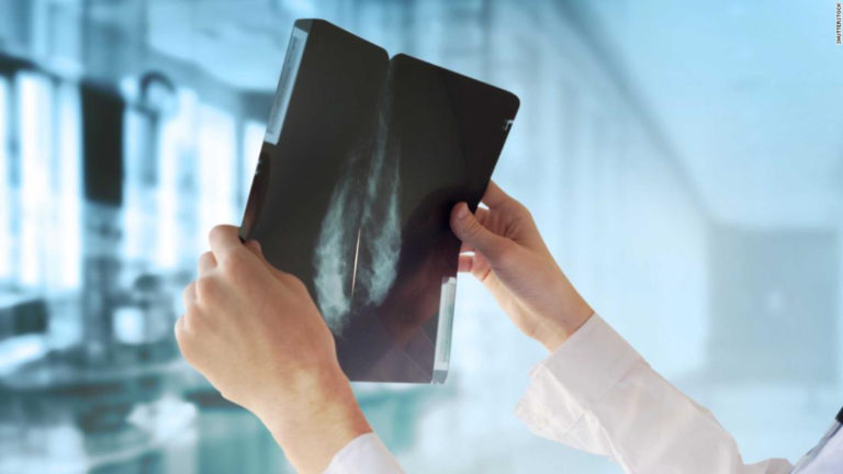 Inteligencia Artificial de Google puede superar a los médicos en detectar el cáncer de seno