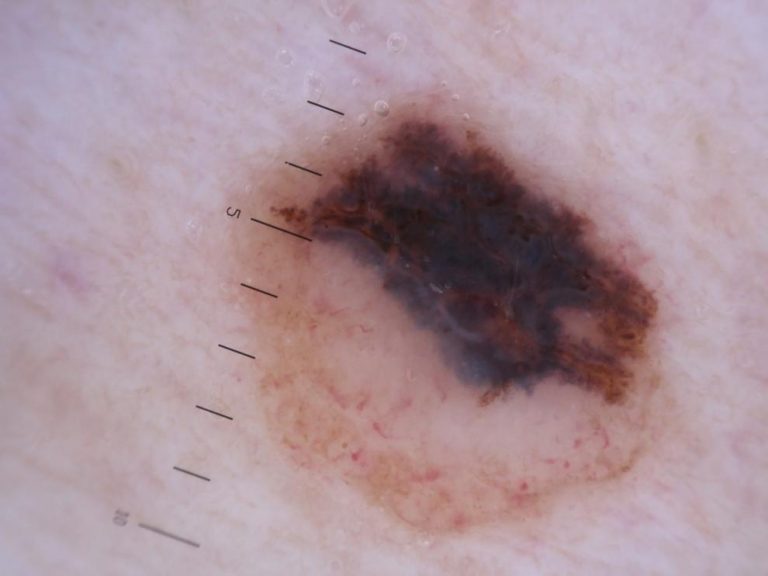 Cómo protegernos del melanoma, el cáncer de piel más mortal