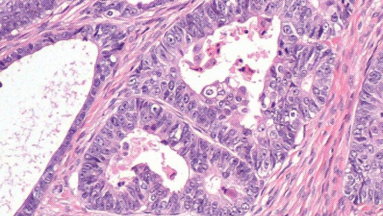 Con éxito droga que mata el cáncer sin dañar tejido sano