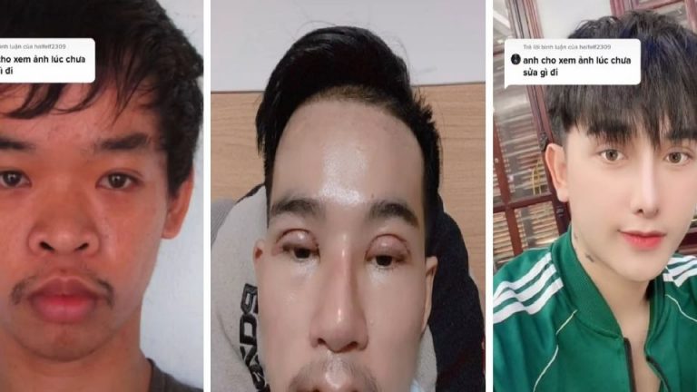 Decide hacerse 9 cirugías en la cara; no le daban trabajo por feo