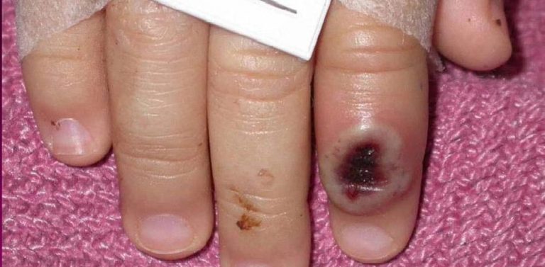 Viruela del mono: cómo se contagia y cuáles son los síntomas