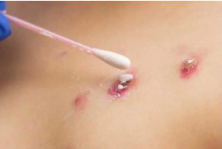 Viruela del mono: cuáles son sus síntomas y cómo prevenirla, la UAS te explica
