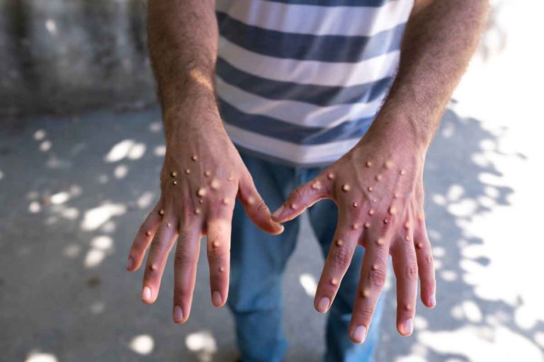 Descarta Sinaloa negativos dos casos de viruela del mono