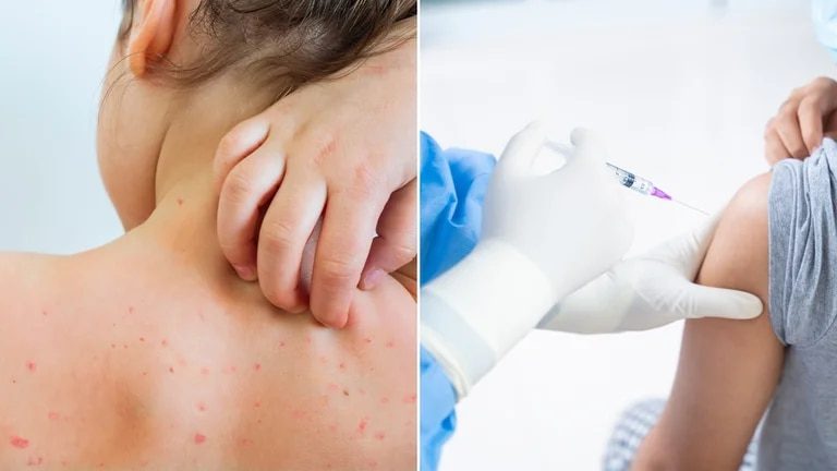 Supera México los mil casos de viruela del mono