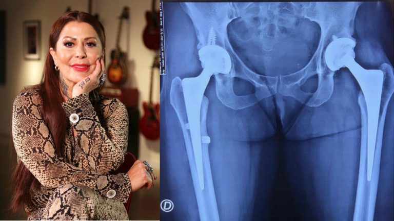 Alejandra Guzmán comparte la radiografía de su cadera luego de la caída