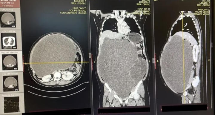 Tumor de 20 kilos y un metro de altura fue extirpado a joven de 18 años