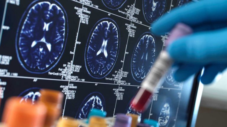 Ralentiza fármaco 60% Alzheimer en fase temprana