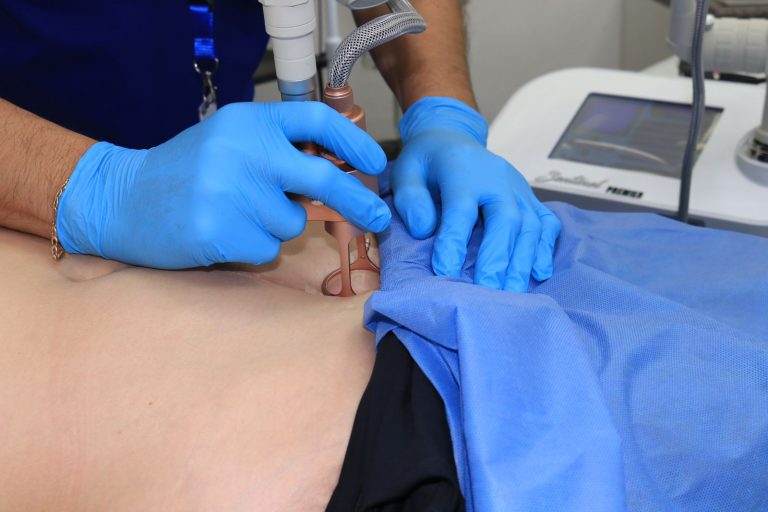 Borran gratis con láser marcas en la piel en Culiacán