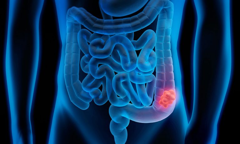 El cáncer colorrectal es la principal causa de muerte en México