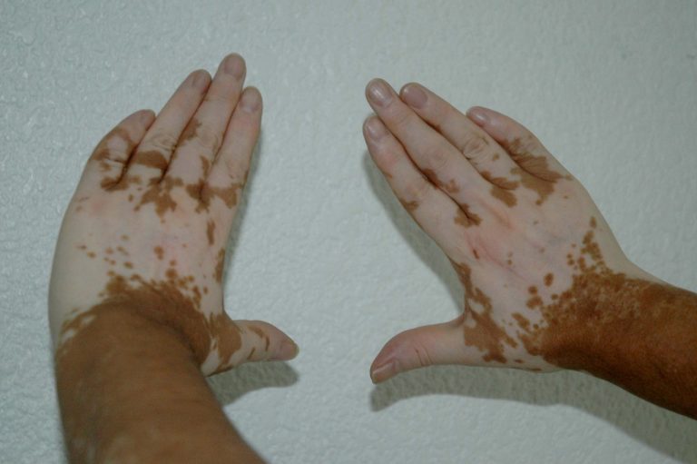 Pacientes con vitiligo, víctimas de estigmas y discriminación