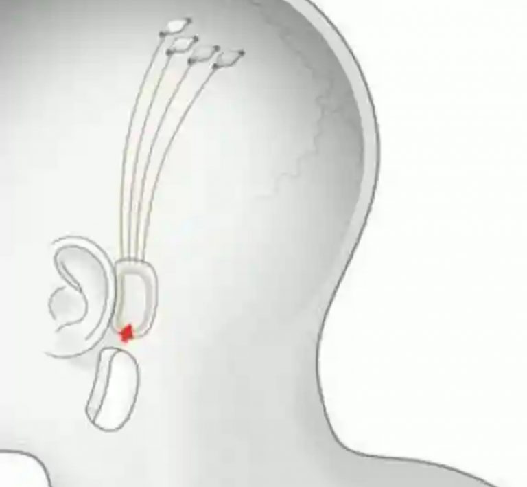 Probará Neuralink chip cerebral para mover brazos robóticos