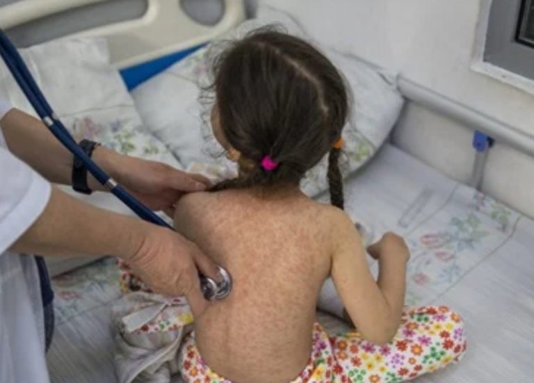 Aprueba OMS primera vacuna para niños contra viruela del mono