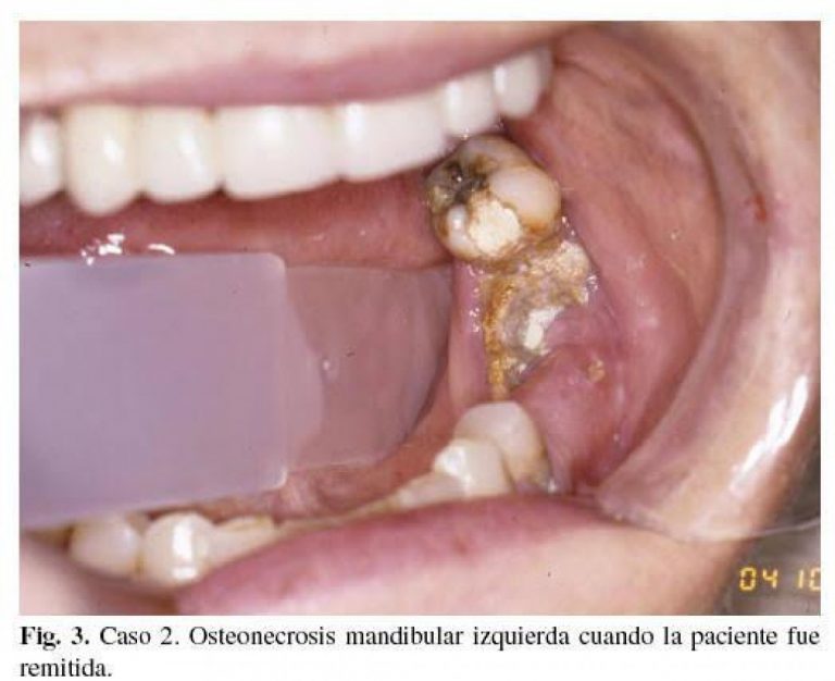 Osteonecrosis, evita que se agrave